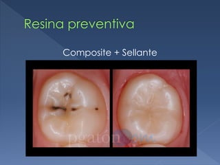 Resina preventiva
Composite + Sellante
 
