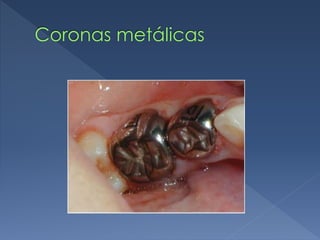 Coronas metálicas
 