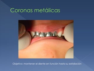 Coronas metálicas
Objetivo: mantener el diente en función hasta su exfoliación
 