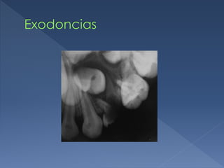 Exodoncias
 