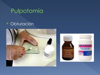 Pulpotomía
⦿ Obturación
 