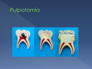 Pulpotomía
 