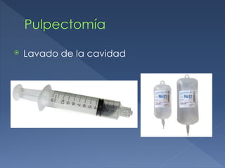 Pulpectomía
⦿ Lavado de la cavidad
 