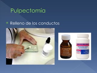 Pulpectomía
⦿ Relleno de los conductos
 