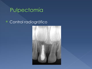 Pulpectomía
⦿ Control radiográfico
 