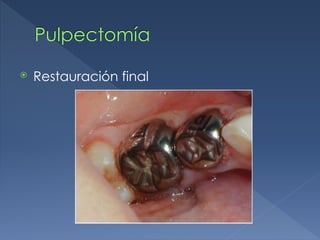 Pulpectomía
⦿ Restauración final
 