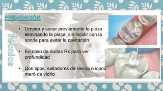• Limpiar y secar previamente la pieza
eliminando la placa, sin incidir con la
sonda para evitar la cavitación.
• En caso de dudas Rx para ver
profundidad
• Dos tipos: selladores de resina e icono
meró de vidrio
 