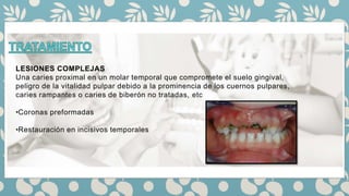 LESIONES COMPLEJAS
Una caries proximal en un molar temporal que compromete el suelo gingival,
peligro de la vitalidad pulpar debido a la prominencia de los cuernos pulpares,
caries rampantes o caries de biberón no tratadas, etc
•Coronas preformadas
•Restauración en incisivos temporales
 