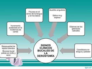 SIGNOS
CLÍNICOS
BUCALES DE
LA
XEROSTOMÍA
Resequedad de
tejidos blandos
Mucosa bucal
pálida sin brillo y
seca
Incremento
acelerado en la
incidencia de
caries
Fisuras en el
dorso de la lengua
y en los labios
Queilitis angulares
Saliva muy
espesa
Edemas de las
glándulas
salivales
Candidiasis en
lengua y paladar
 