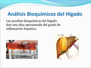 Análisis Bioquímicos del Hígado
Las pruebas bioquímicas del hígado
dan una idea aproximada del grado de
inflamación hepática.
 