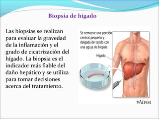 Biopsia de hígado
Las biopsias se realizan
para evaluar la gravedad
de la inflamación y el
grado de cicatrización del
hígado. La biopsia es el
indicador más fiable del
daño hepático y se utiliza
para tomar decisiones
acerca del tratamiento.
 