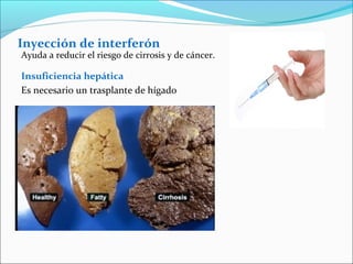 Inyección de interferón
Ayuda a reducir el riesgo de cirrosis y de cáncer.
Insuficiencia hepática
Es necesario un trasplante de hígado
 