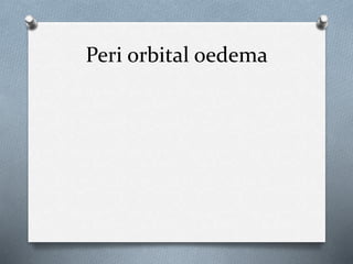 Peri orbital oedema
 