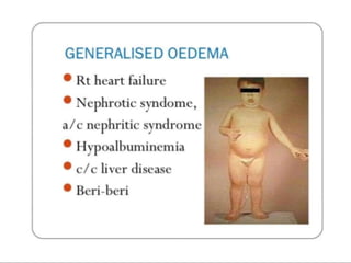 OEDEMA.pptx............................. .