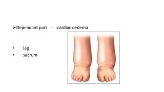 Dependant part - cardiac oedema
• leg
• sacrum
 