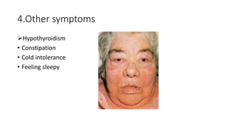 4.Other symptoms
Hypothyroidism
• Constipation
• Cold intolerance
• Feeling sleepy
 