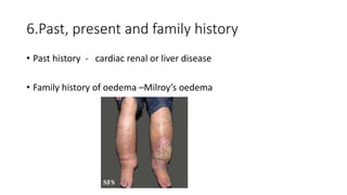 6.Past, present and family history
• Past history - cardiac renal or liver disease
• Family history of oedema –Milroy’s oedema
 