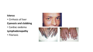 Icterus
• Cirrhosis of liver
Cyanosis and clubbing
• Cardiac oedema
Lymphadenopathy
• Filariasis
 