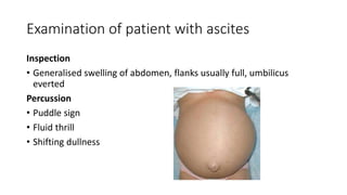 Examination of patient with ascites
Inspection
• Generalised swelling of abdomen, flanks usually full, umbilicus
everted
Percussion
• Puddle sign
• Fluid thrill
• Shifting dullness
 
