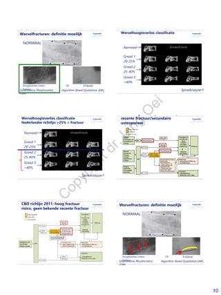 10
Wervelfracturen: definitie moeilijk
Hoogteverlies meten OF Eindplaat
fractuur
NORMAAL
Quantitative Morphometry
(QM)
Algorithm-Based Qualitative (ABQ)
Wervelhoogteverlies classificatie
SpineAnalyzer®
Normaal
Graad 1
20-25%
Graad 2
25-40%
Graad 3
>40%
Wervelhoogteverlies classificatie
Nederlandse richtlijn >25% = fractuur
SpineAnalyzer®
Normaal
Graad 1
20-25%
Graad 2
25-40%
Graad 3
>40%
CBO richlijn 2011: (vermoeden)
recente fractuur/secundaire
osteoporose
CBO richlijn 2011: hoog fractuur
risico, geen bekende recente fractuur
Wervelfracturen: definitie moeilijk
Hoogteverlies meten OF Eindplaat
fractuur
NORMAAL
Quantitative Morphometry
(QM)
Algorithm-Based Qualitative (ABQ)
C
opyrightdr.Ling
O
ei
 