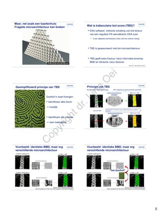 5
Maar, net zoals een kaartenhuis:
Fragiele microarchitectuur kan breken
Wat is trabeculaire bot score (TBS)?
• DXA software: indirecte schatting van bot textuur
van een reguliere PA wervelkolom DXA scan
• Is een afgeleide eenheidsloze index (niet een directe meting)
• TBS is geassocieerd met bot microarchitectuur
• TBS geeft extra fractuur risico informatie bovenop
BMD en klinische risico factoren
Silva et al. J Bone Miner Res 2014
Gesimplificeerd principe van TBS
Doolhof in kaart brengen:
• Identificeer elke boom
-> moeilijk
• Identificeer alle ruimtes
-> veel makkelijker
Principe van TBS
TBS L1-L4: 1.457
TBS L1-L4: 1.132
Identieke BMD
Goede microarchitectuur
Homogeen
Slechte microarchitectuur
Heteroogeen
Bot Mineraal Dichtheid images TBS mapping en geassocieerde waarden
Quantification of the texture using a modified experimental variogram
approach
Voorbeeld: identieke BMD, maar erg
verschillende microarchitectuur
Oei et al. Quant Imaging Med Surg 2016
Figuren aangepast van http://www.medimapsgroup.com/product/technology/
Voorbeeld: identieke BMD, maar erg
verschillende microarchitectuur
Oei et al. Quant Imaging Med Surg 2016
Figuren aangepast van http://www.medimapsgroup.com/product/technology/
“het doolhof”
C
opyrightdr.Ling
O
ei
 