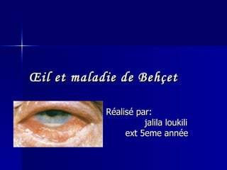 Œil et maladie de Behçet Réalisé par:  jalila loukili ext 5eme année 