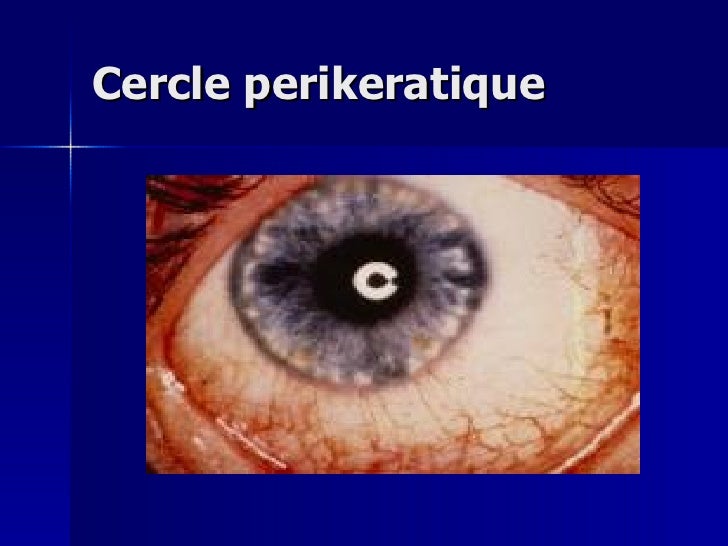 Maladie De Behçet Peut On En Mourir Oeil Et Maladie de Behçet