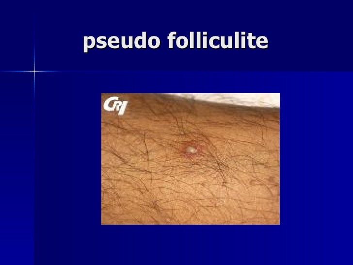 Maladie De Behçet Peut On En Mourir Oeil Et Maladie de Behçet
