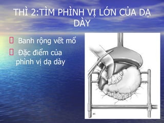 THÌ 2:TÌM PHÌNH VỊ LỚN CỦA DẠ
DÀY
Banh rộng vết mổ
Đặc điểm của
phình vị dạ dày
 
