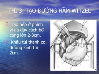 THÌ 3: TẠO ĐƯỜNG HẦM WITZEL
Tạo nếp ở phình
vị dạ dày cách bờ
cong lớn 2-3cm.
Khâu túi thanh cơ,
đường kính túi
2cm.
 