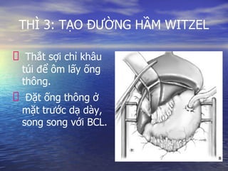THÌ 3: TẠO ĐƯỜNG HẦM WITZEL
Thắt sợi chỉ khâu
túi để ôm lấy ống
thông.
Đặt ống thông ở
mặt trước dạ dày,
song song với BCL.
 