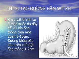 THÌ 3: TẠO ĐƯỜNG HẦM WITZEL
Khâu vắt thanh cơ
ở mặt trước dạ dày
để vùi kín ống
thông trên một
đoạn 8-10cm.
Đường khâu bắt
đầu trên chỗ đặt
ống thông 1-2cm.
 