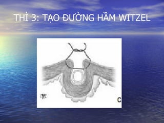 THÌ 3: TẠO ĐƯỜNG HẦM WITZEL
 