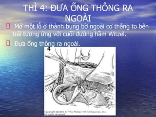 THÌ 4: ĐƯA ỐNG THÔNG RA
NGOÀI
Mở một lỗ ở thành bụng bờ ngoài cơ thẳng to bên
trái tương ứng với cuối đường hầm Witzel.
Đưa ống thông ra ngoài.
 