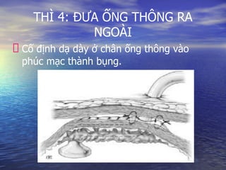 THÌ 4: ĐƯA ỐNG THÔNG RA
NGOÀI
Cố định dạ dày ở chân ống thông vào
phúc mạc thành bụng.
 