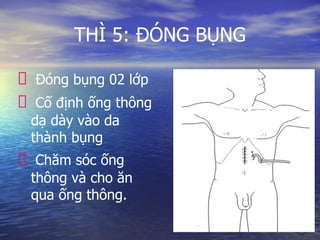 THÌ 5: ĐÓNG BỤNG
Đóng bụng 02 lớp
Cố định ống thông
dạ dày vào da
thành bụng
Chăm sóc ống
thông và cho ăn
qua ống thông.
 