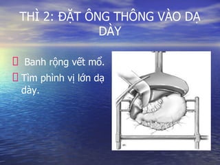 THÌ 2: ĐẶT ÔNG THÔNG VÀO DẠ
DÀY
Banh rộng vết mổ.
Tìm phình vị lớn dạ
dày.
 