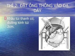 THÌ 2: ĐẶT ÔNG THÔNG VÀO DẠ
DÀY
Khâu túi thanh cơ,
đường kính túi
2cm.
 