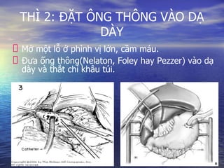 THÌ 2: ĐẶT ÔNG THÔNG VÀO DẠ
DÀY
Mở một lỗ ở phình vị lớn, cầm máu.
Đưa ống thông(Nelaton, Foley hay Pezzer) vào dạ
dày và thắt chỉ khâu túi.
 