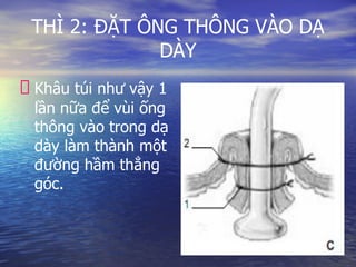 THÌ 2: ĐẶT ÔNG THÔNG VÀO DẠ
DÀY
Khâu túi như vậy 1
lần nữa để vùi ống
thông vào trong dạ
dày làm thành một
đường hầm thẳng
góc.
 