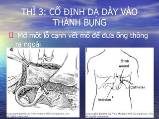 THÌ 3: CỐ ĐỊNH DẠ DÀY VÀO
THÀNH BỤNG
Mở một lỗ cạnh vết mổ để đưa ống thông
ra ngoài
 