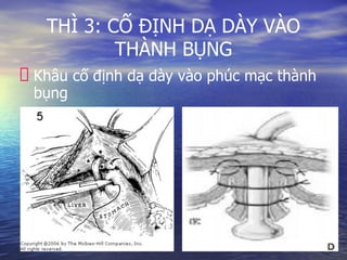THÌ 3: CỐ ĐỊNH DẠ DÀY VÀO
THÀNH BỤNG
Khâu cố định dạ dày vào phúc mạc thành
bụng
 