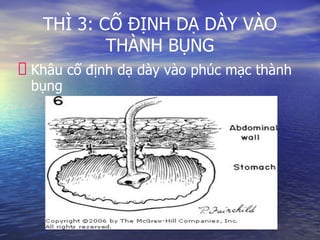 THÌ 3: CỐ ĐỊNH DẠ DÀY VÀO
THÀNH BỤNG
Khâu cố định dạ dày vào phúc mạc thành
bụng
 
