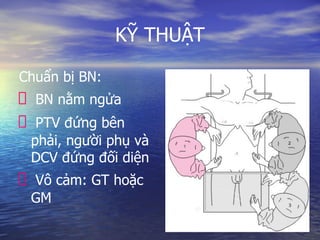 KỸ THUẬT
Chuẩn bị BN:
BN nằm ngửa
PTV đứng bên
phải, người phụ và
DCV đứng đối diện
Vô cảm: GT hoặc
GM
 