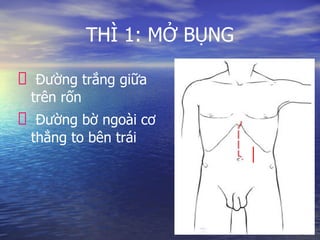 THÌ 1: MỞ BỤNG
Đường trắng giữa
trên rốn
Đường bờ ngoài cơ
thẳng to bên trái
 