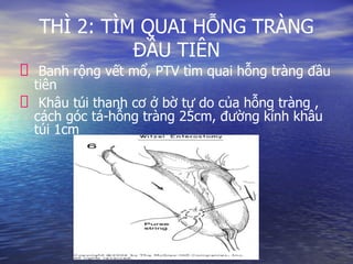 THÌ 2: TÌM QUAI HỖNG TRÀNG
ĐẦU TIÊN
Banh rộng vết mổ, PTV tìm quai hỗng tràng đầu
tiên
Khâu túi thanh cơ ở bờ tự do của hỗng tràng ,
cách góc tá-hỗng tràng 25cm, đường kính khâu
túi 1cm
 