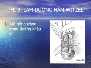 THÌ 3: LÀM ĐƯỜNG HẦM WITZEL
Mở hỗng tràng
trong đường khâu
túi
 