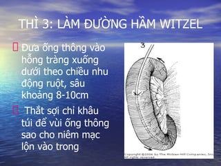 THÌ 3: LÀM ĐƯỜNG HẦM WITZEL
Đưa ống thông vào
hỗng tràng xuống
dưới theo chiều nhu
động ruột, sâu
khoảng 8-10cm
Thắt sợi chỉ khâu
túi để vùi ống thông
sao cho niêm mạc
lộn vào trong
 