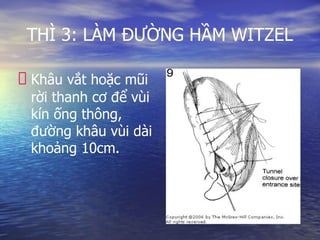 THÌ 3: LÀM ĐƯỜNG HẦM WITZEL
Khâu vắt hoặc mũi
rời thanh cơ để vùi
kín ống thông,
đường khâu vùi dài
khoảng 10cm.
 