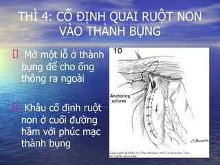 THÌ 4: CỐ ĐỊNH QUAI RUỘT NON
VÀO THÀNH BỤNG
Mở một lỗ ở thành
bụng để cho ống
thông ra ngoài
Khâu cố định ruột
non ở cuối đường
hầm với phúc mạc
thành bụng
 